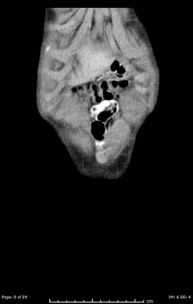 File:Agenesis of the gallbladder (Radiopaedia 55454-61905 A 5).jpg