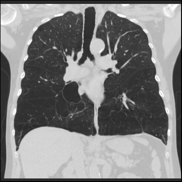 File:Alpha-1-antitrypsin deficiency (Radiopaedia 40993-43722 Coronal lung window 52).jpg