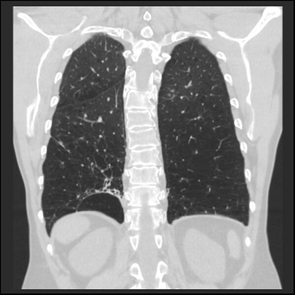 File:Alpha-1-antitrypsin deficiency (Radiopaedia 40993-43722 Coronal lung window 82).jpg