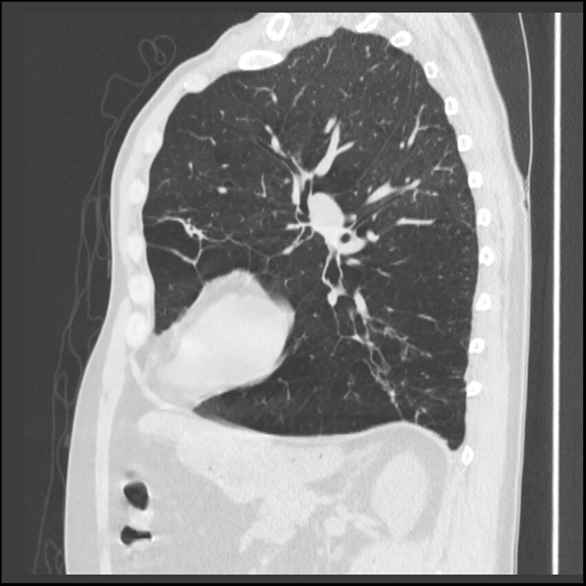 Alpha-1-antitrypsin deficiency (Radiopaedia 40993-43722 Sagittal lung window 96).jpg