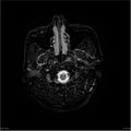Amnestic syndrome secondary to hypoxic brain injury (Radiopaedia 24743-25004 DWI 35).jpg