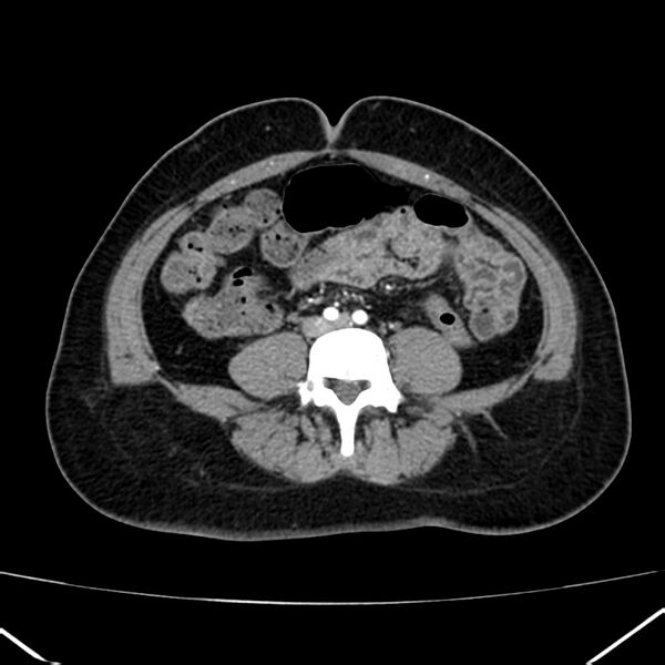 File:Ampullary tumor (Radiopaedia 22787-22816 B 58).jpg