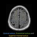 Anatomy- sulci of the brain (Radiopaedia 33834-34995 Central sulcus 7).jpg