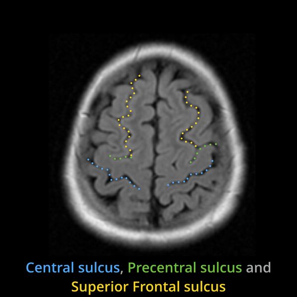 File:Anatomy- sulci of the brain (Radiopaedia 33834-34995 Central sulcus 7).jpg