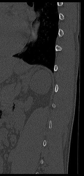 File:Aneurysmal bone cyst T11 (Radiopaedia 29294-29721 Sagittal bone window 16).jpg