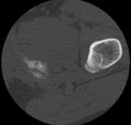 Aneurysmal bone cyst of ischium (Radiopaedia 25957-26094 B 54).png