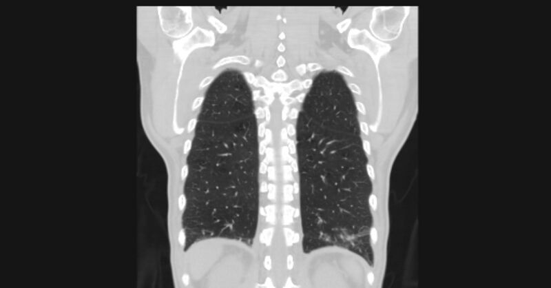 File:Angioinvasive aspergellosis (Radiopaedia 66995-76315 Coronal lung window 51).jpg