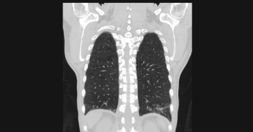 Angioinvasive aspergellosis (Radiopaedia 66995-76315 Coronal lung window 51).jpg