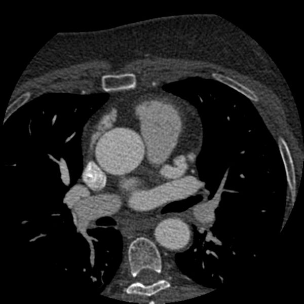 File:Anomalous origin of left circumflex artery from right coronary sinus (Radiopaedia 72563-83117 B 25).jpg