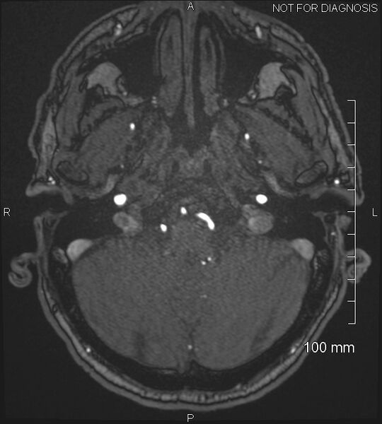 File:Anterior cerebral artery aneurysm (Radiopaedia 80683-94127 Axial MRA 36).jpg