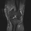 Anterior cruciate ligament full thickness tear (Radiopaedia 66268-75467 Coronal STIR 12).jpg