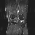 Anterior cruciate ligament full thickness tear (Radiopaedia 66268-75467 Coronal STIR 16).jpg