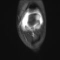 Anterior cruciate ligament tear - pediatric (Radiopaedia 62152-70260 Coronal PD fat sat 24).jpg