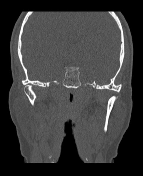 File:Antrochoanal polyp (Radiopaedia 79011-92169 Coronal bone window 1).jpg