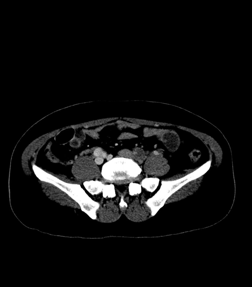 Aortic dissection with renal ischemia (Radiopaedia 76573-88338 B 50).jpg