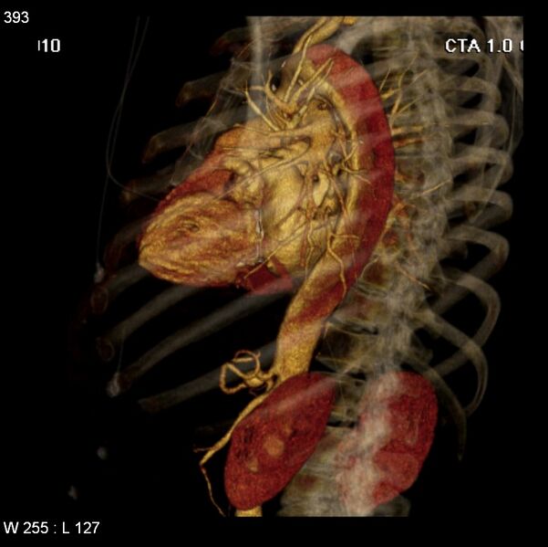 File:Aortic dissection with rupture into pericardium (Radiopaedia 12384-12647 C+ arterial phase 25).jpg