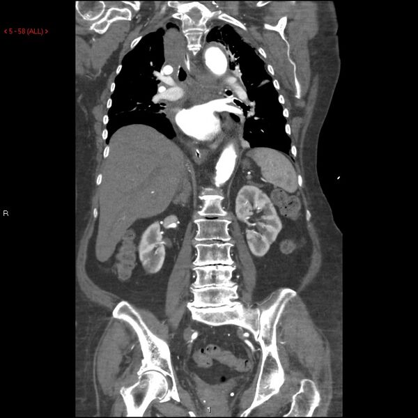 File:Aortic intramural hematoma (Radiopaedia 27746-28001 B 35).jpg