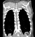 Aortic valve non-coronary cusp thrombus (Radiopaedia 55661-62189 C 66).png