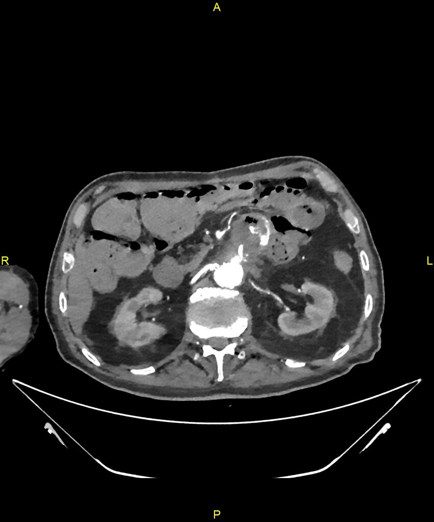 Aortoenteric fistula (Radiopaedia 84308-99603 B 119).jpg