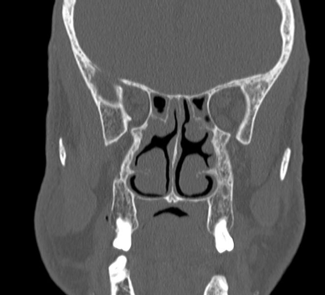 File:Aplastic maxillary sinuses (Radiopaedia 60030-67561 Coronal non-contrast 23).jpg