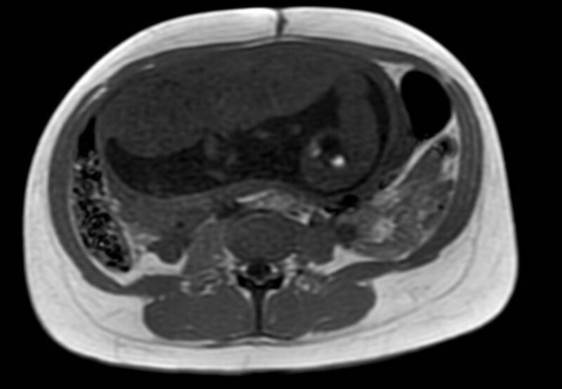 File:Appendicitis in gravida (MRI) (Radiopaedia 89433-106395 Axial T1 in-phase 36).jpg