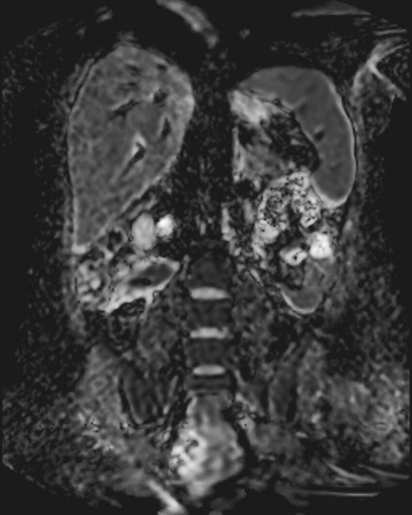 Appendicitis in gravida (MRI) (Radiopaedia 89433-106395 Coronal ADC 35).jpg