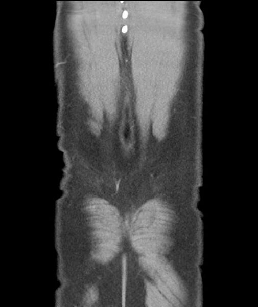 File:Appendicitis with cecal bar sign (Radiopaedia 31878-32830 A 57).jpg