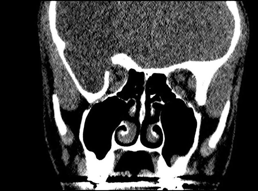 Arachnoid cyst- extremely large (Radiopaedia 68741-78450 Coronal bone window 41).jpg