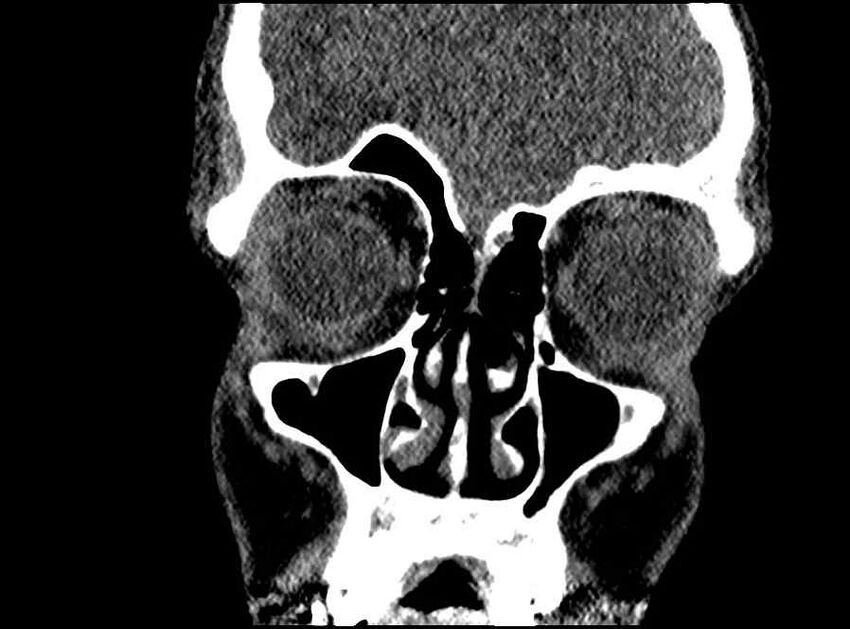 Arachnoid cyst- extremely large (Radiopaedia 68741-78450 Coronal bone window 59).jpg