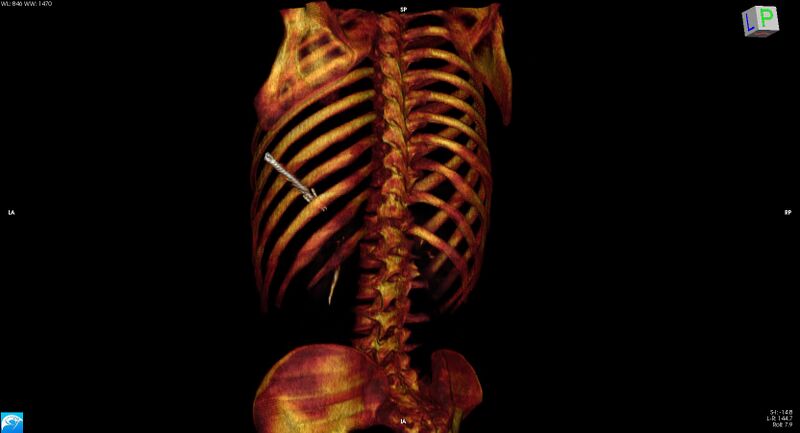 File:Arrow injury to the chest (Radiopaedia 75223-86321 3D bone 19).jpg