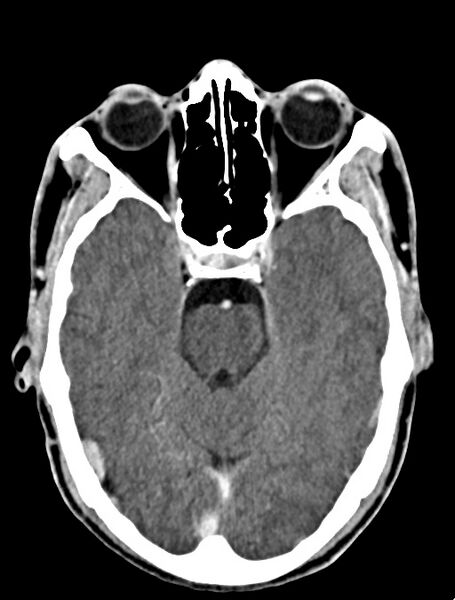 File:Arrow injury to the face (Radiopaedia 73267-84011 Axial C+ delayed 45).jpg