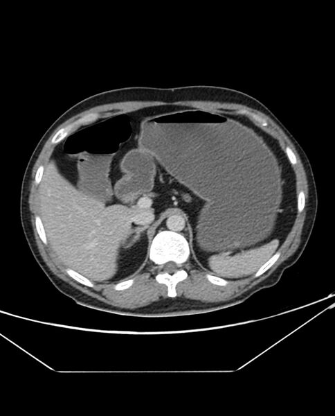 File:Arterial occlusive mesenteric ischemia (Radiopaedia 84641-100054 A 31).jpg