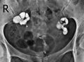 Asherman syndrome and bilateral hydrosalpinges (Radiopaedia 85444-101081 Frontal 1).jpg