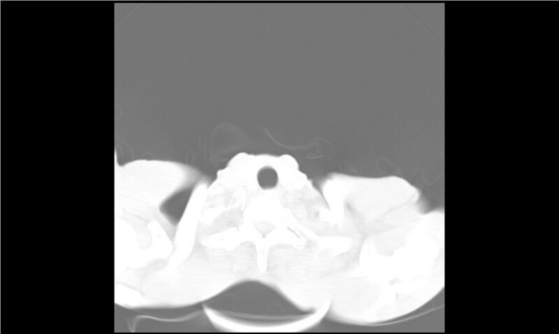 File:Aspergilloma (Radiopaedia 20788-20701 Axial lung window 1).jpg