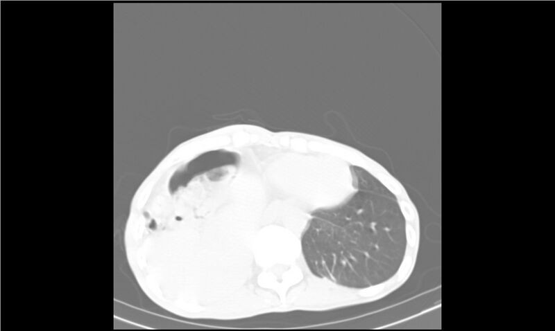 File:Aspergilloma (Radiopaedia 20788-20701 Axial lung window 33).jpg