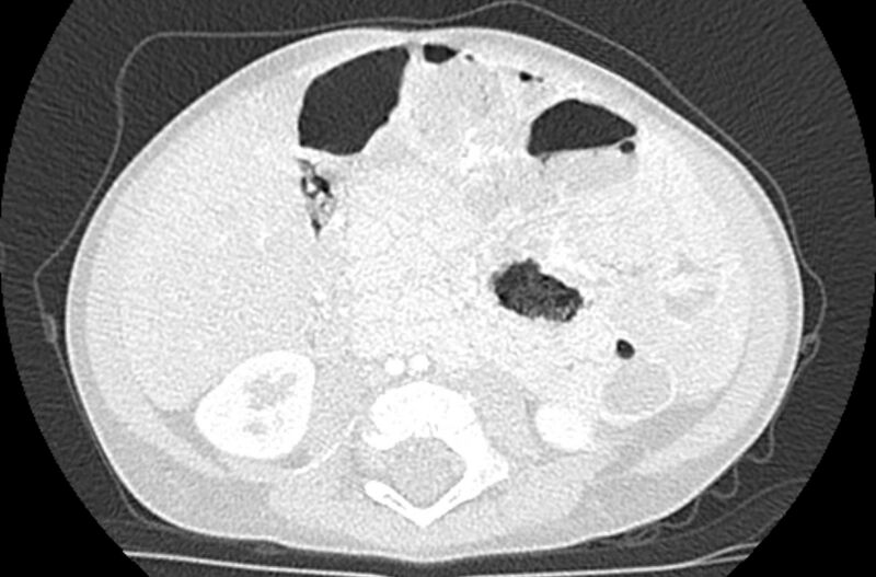 File:Asplenia syndrome (Radiopaedia 73083-83792 Axial lung window 105).jpg
