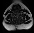 Astrocytoma - spinal cord (Radiopaedia 69769-79758 Axial T2 13).jpg