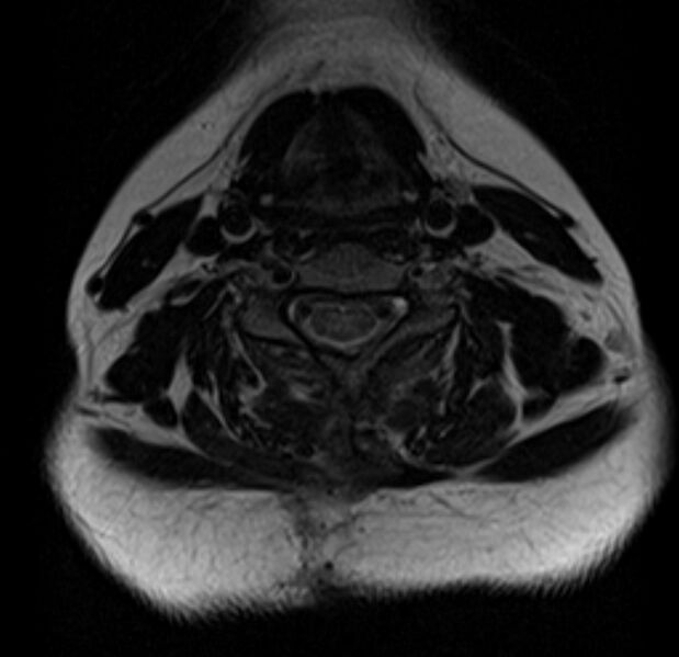 File:Astrocytoma - spinal cord (Radiopaedia 69769-79758 Axial T2 13).jpg