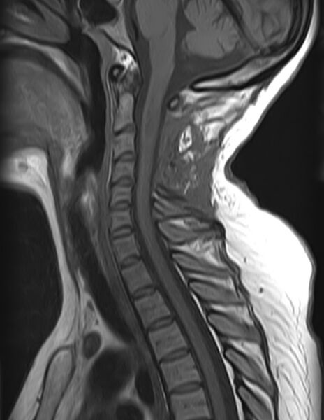 File:Astrocytoma - spinal cord (Radiopaedia 69769-79758 Sagittal T1 7).jpg