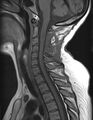 Astrocytoma - spinal cord (Radiopaedia 69769-79758 Sagittal T1 7).jpg