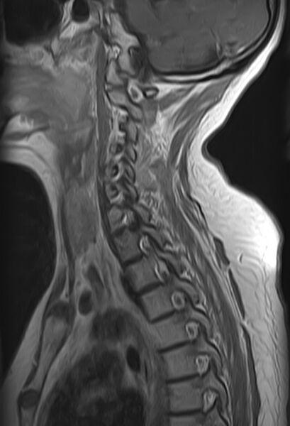 File:Astrocytoma - spinal cord (Radiopaedia 69769-79758 Sagittal T1 C+ 9).jpg