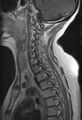 Astrocytoma - spinal cord (Radiopaedia 69769-79758 Sagittal T1 C+ 9).jpg