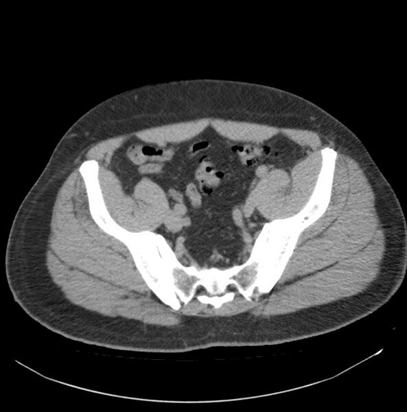 File:Atrophic kidney due to severe chronic obstructive hydronephrosis (Radiopaedia 40828-43474 Axial non-contrast 35).jpg