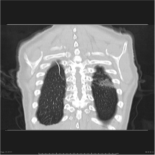 File:Atypical pneumonia - Q fever (Radiopaedia 21993-21989 C 40).jpg