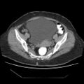 Atypical retroperitoneal lymphocoeles with large leiomyoma of uterus (Radiopaedia 32084-33024 A 30).jpg