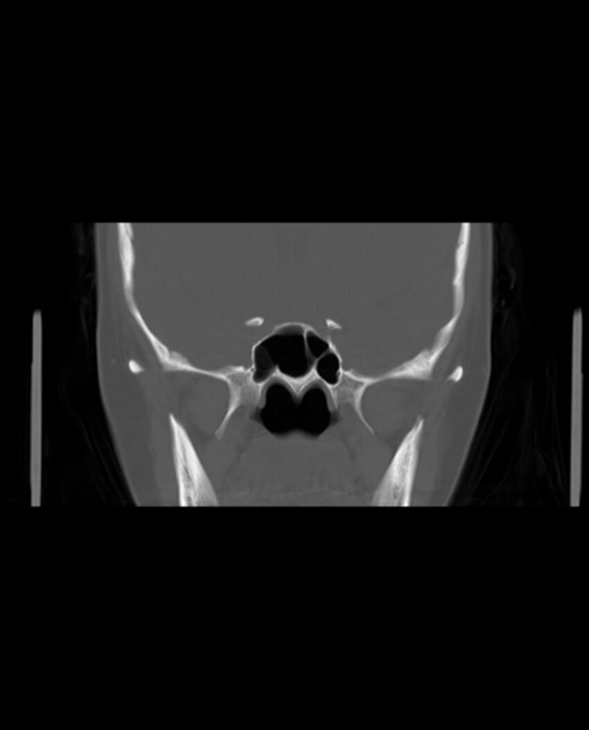 Automastoidectomy with labyrinthine fistula (Radiopaedia 84143-99411 Coronal non-contrast 64).jpg