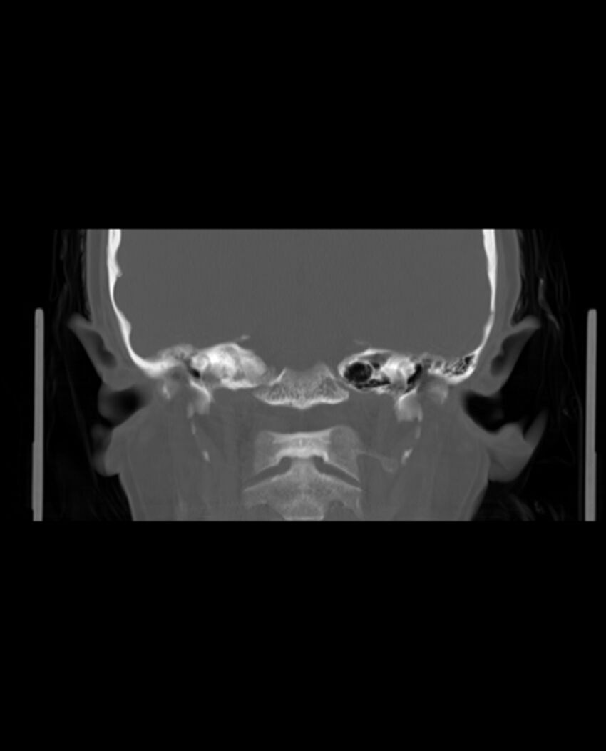Automastoidectomy with labyrinthine fistula (Radiopaedia 84143-99411 Coronal non-contrast 89).jpg