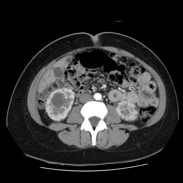 File:Autosomal dominant polycystic kidney disease (Radiopaedia 23061-23093 B 38).jpg