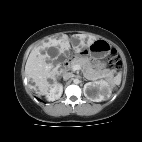 File:Autosomal dominant polycystic kidney disease (Radiopaedia 23061-23093 C 21).jpg