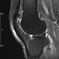Avulsion fracture of the fibular head (Radiopaedia 74804-85808 Sagittal PD fat sat 22).jpg